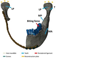 CT based 3D FE model of mandible using Simpleware software (CC BY 4.0)