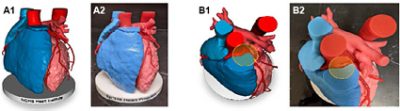 Segmentation of breast tumor | 