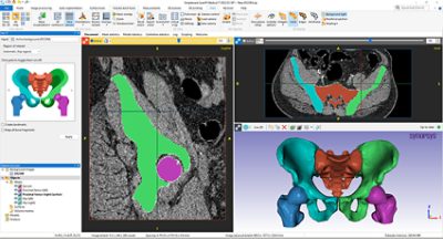 Automated pelvic CT segmentation using Simpleware AS Ortho