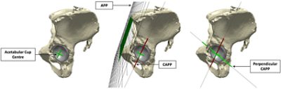 Models of a pelvis and Birmingham hip replacement (BHR) implant in Simpleware ScanIP (CC BY 4.0)