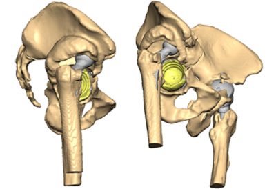 3D models of hips and implants for surgical planning
