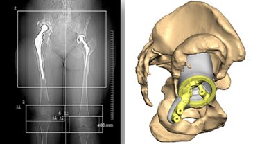 bone preserving