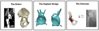 Workflow for next generation 3D printed implants (CC BY 4.0)