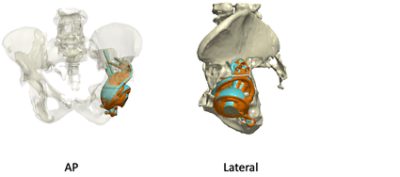 Custom 3D printed cups for acetabular reconstruction