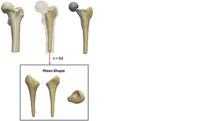 Examples of different femoral canals used for a Statistical Shape Modelling (SSM) study