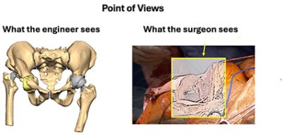 Comparison of perspective between implant designer and surgeon during surgery.