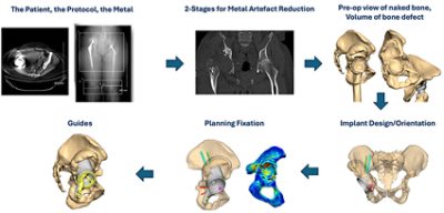 3D planning workflow for planning custom implants