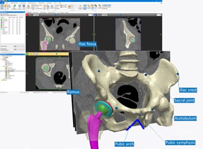 Segmentation of a hip using Simpleware 3D medical imaging software