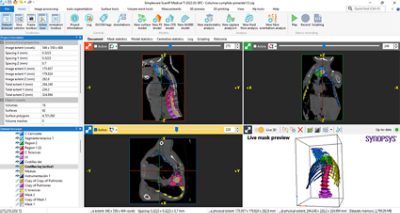 Spine segmentation using Synopsys Simpleware software