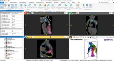 Spine segmentation using ϲֱ Simpleware software