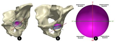 Acetabular surface registered to the 3D model of its acetabular cup (CC BY 4.0)