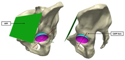 CAPP axis defined using a plane parallel to the APP (CC BY 4.0)