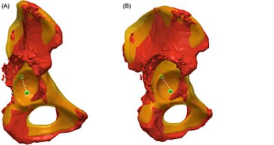 Difference in center of rotation (CoR) between the SSM and the scanned hip (CC BY 4.0)