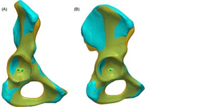 Difference in CoR between the SSM and the contralateral healthy side (CC BY 4.0)