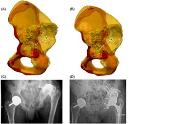 Difference in center of rotation (CoR) between the SSM and the scanned hip (CC BY 4.0)