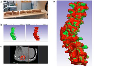 Superimposition and surface deviation analysis using Simpleware (CC BY 4.0)