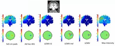 FE simulation to determine optimal electrode configuration for tDCS