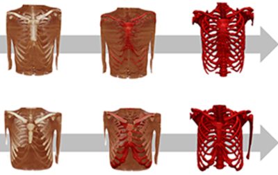 <p>Virtual testing of the human body from imaging data is important for mitigating against the ethical and practical problems of physical experiments. In this study, <a href="https://www.toyota.co.jp/thums/" target="_blank">Toyota's Total Human Model for Safety (THUMS)</a> was adapted by JSOL and Nagano Children's Hospital from automotive safety applications to the medical challenge of modeling pectus excavatum, a type of deformity of the thorax that is also known as funnel chest.</p>
<p>°ϲʿ Simpleware software was used in this project to create a realistic patients thorax structure from CT data suitable for morphing to THUMS' detailed FE model, and provided the basis for simulating the growth of costal cartilage after operations.</p>
