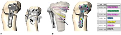 3D HTO geometries created using  Simpleware software for designing a surgical guide in Ansys SpaceClaim