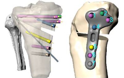 Personalized 3D printed high tibial osteotomy (HTO)