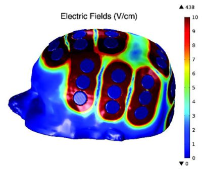 Alternating electric fields or tumor treating fields (TTFields) therapy, is a type of electromagnetic field therapy to treat cancer, particularly recurrent glioblastoma. TTFields therapy delivers low-intensity electric currents through arrays on the scalp and has demonstrated good results compared to traditional methods.
However, the precise distribution of TTFields within the brain, and the extent to which they cover the recurrent glioblastoma, remains poorly understood. Computational simulation from medical image data offers a solution for analyzing the effect of TTFields therapy for the treatment of glioblastoma. Simpleware software was used to generate models for this purpose.
